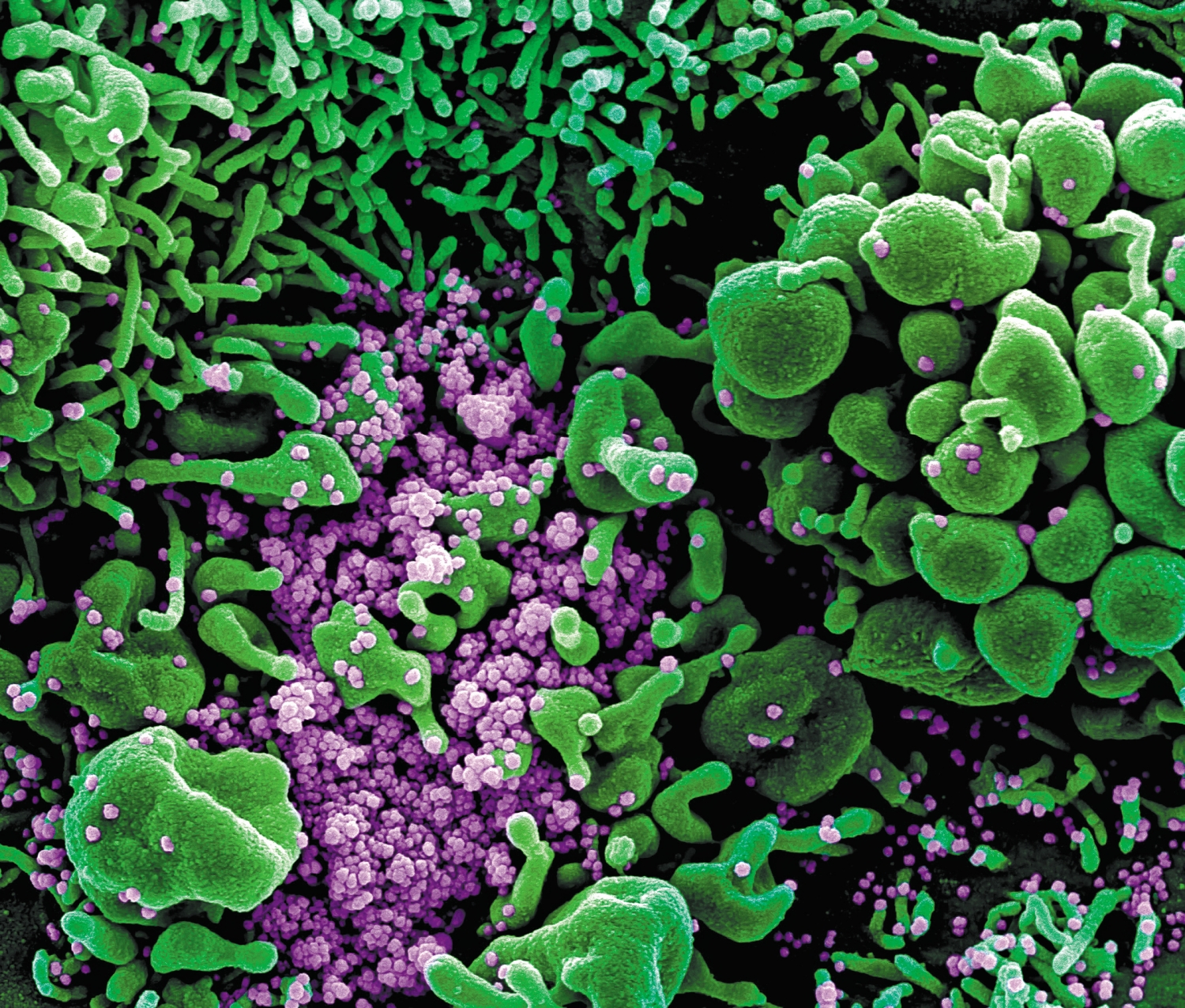 從患者體內提取的SARS-CoV-2 病毒樣本，可見病毒顆粒（紫色）已經嚴重感染周邊細胞／ NIAID 提供（來源：https://www.flickr.com/photos/niaid/49666286236/）